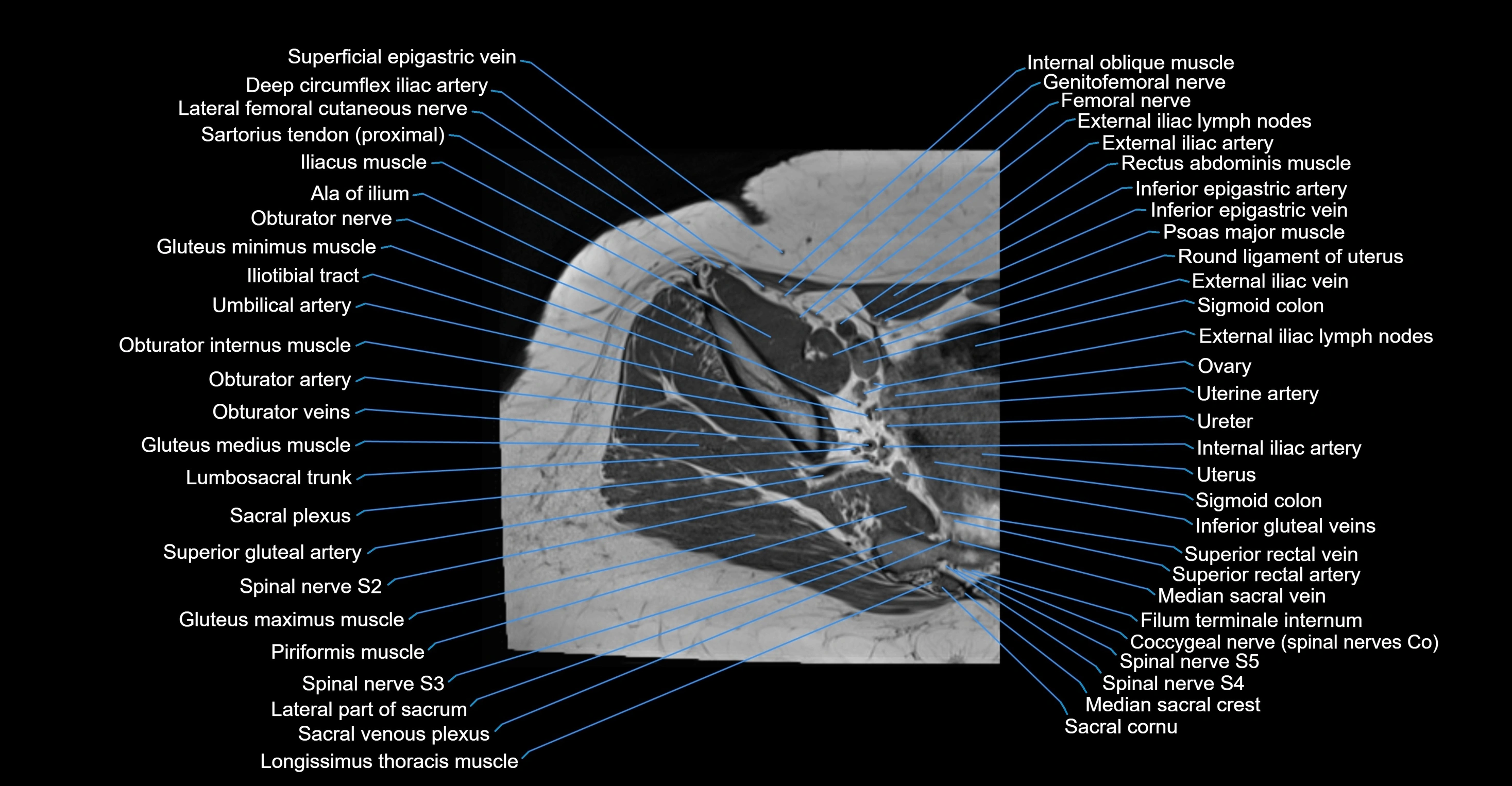 MRI hip axial cross sectional anatomy 3T 3D  radiology  anatomy image-img-00001-00011.webp